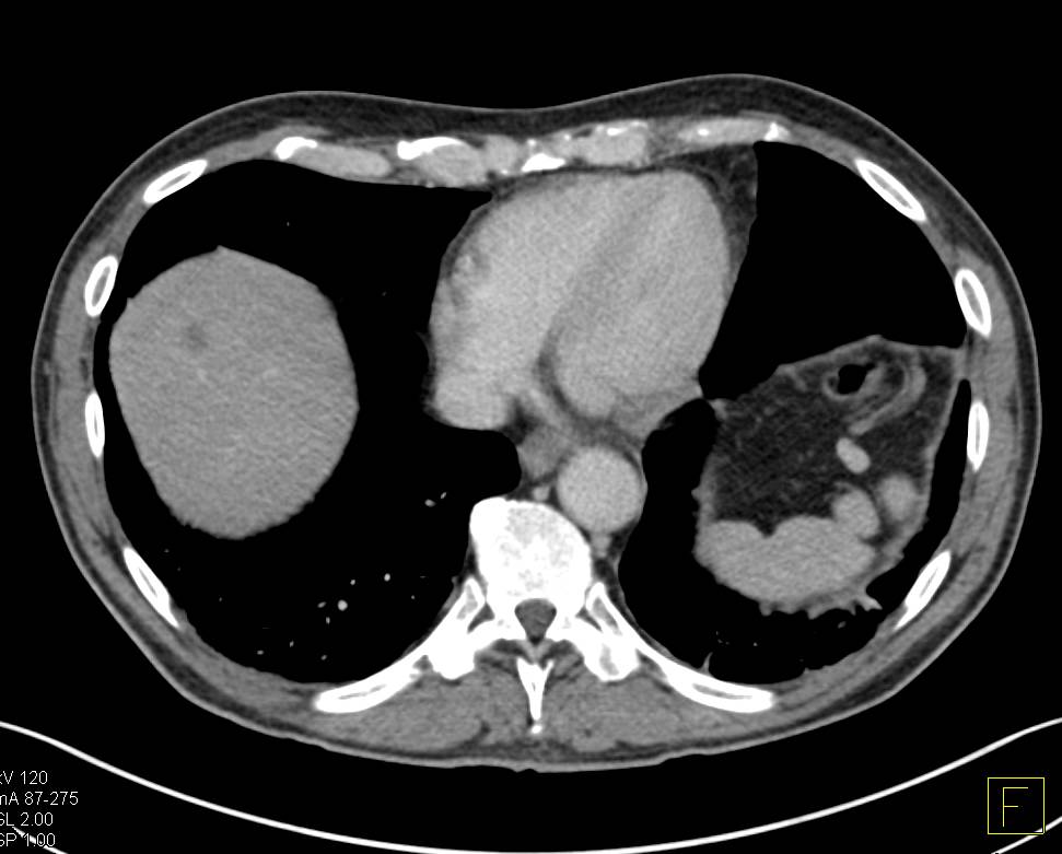 Liver and Lung Metastases from Pancreatic Cancer Liver