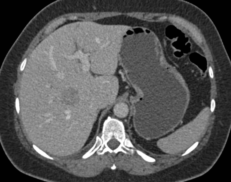 Atypical Hemangioma looks like Liver Metastasis - Liver Case Studies