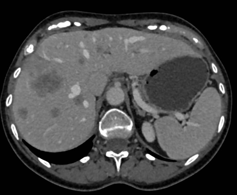 Necrotic Liver Metastases due to Metastatic GIST Tumor - Liver Case