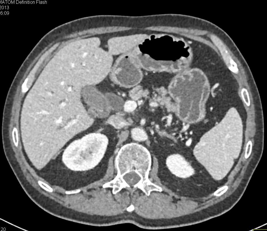 Distal Common Bile Duct Cancer - Liver Case Studies - CTisus CT Scanning
