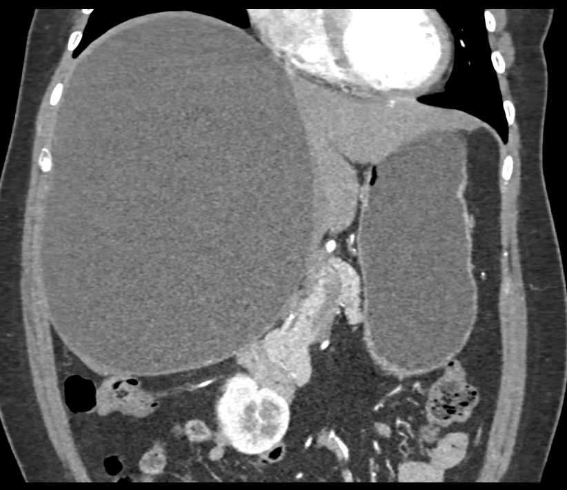 Large Simple Hepatic Cyst - Liver Case Studies - CTisus CT Scanning