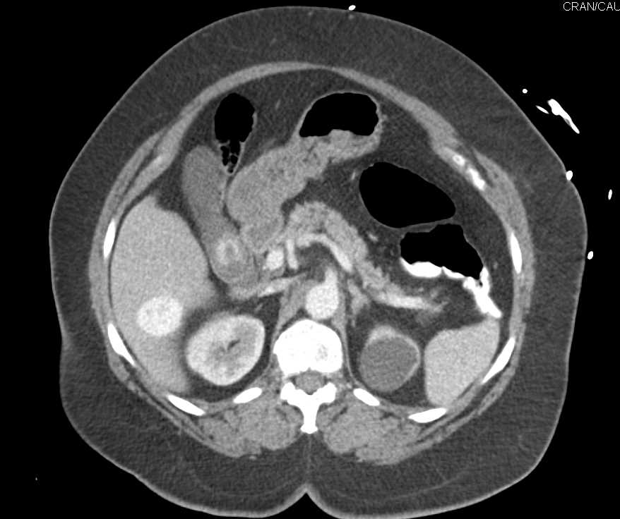 Focal Nodular Hyperplasia Liver - Liver Case Studies - CTisus CT Scanning