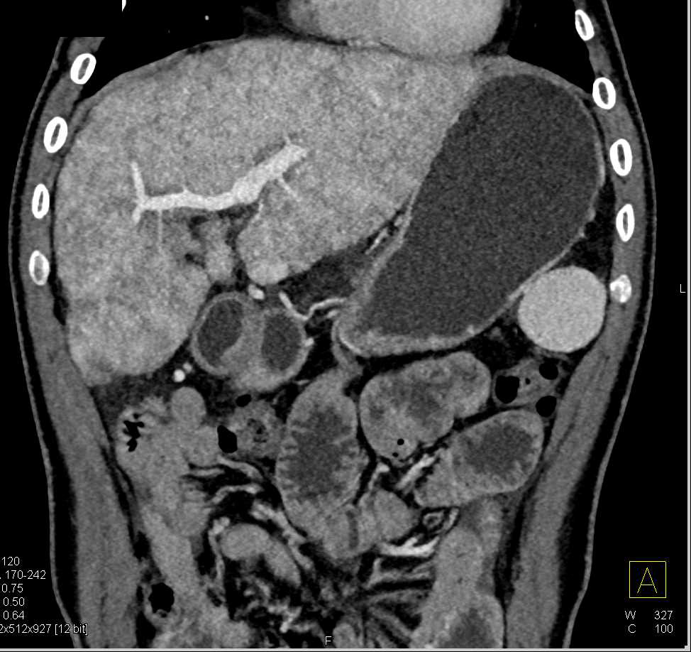 Cirrhosis Of The Liver With Hepatic Congestion Liver Case Studies