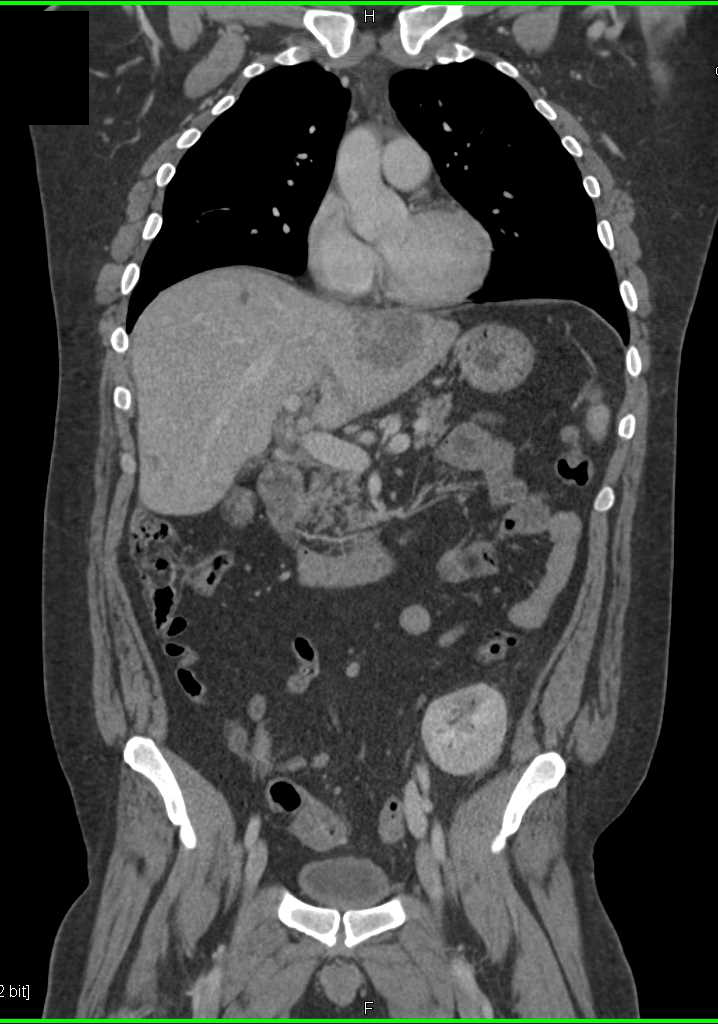 Liver Metastases from Colon Cancer - Liver Case Studies - CTisus CT