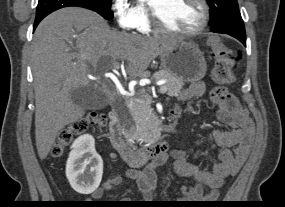 Dilated Common Bile Duct with Impacted Stone - Liver Case Studies