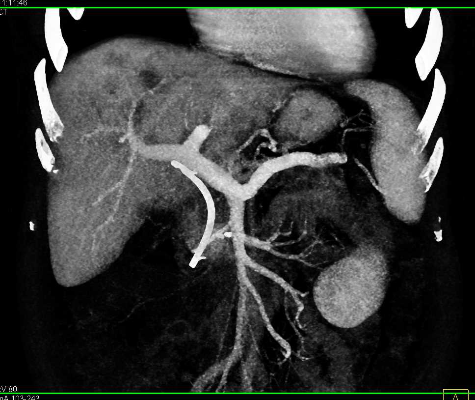 Pancreatic Cancer with Liver Metastases - CTisus CT Scan