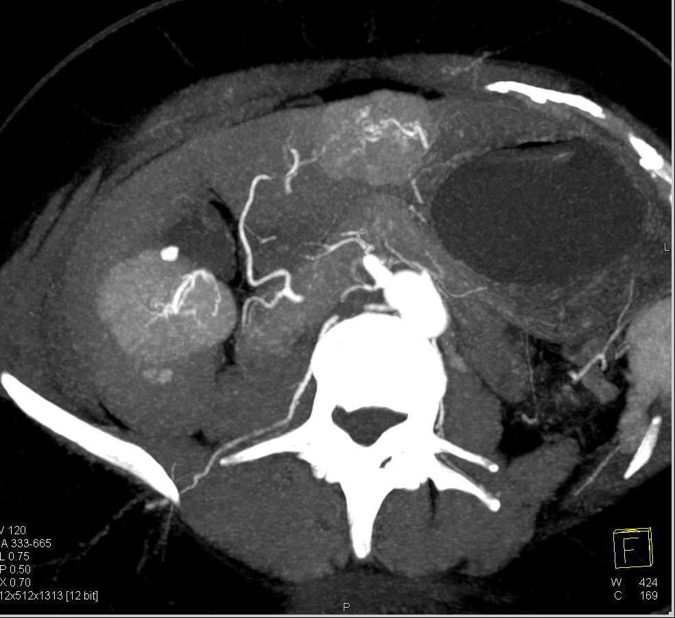 Classic Focal Nodular Hyperplasia Liver With Multiple Lesions In A