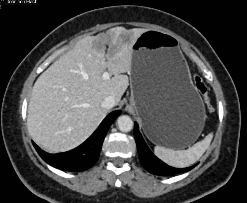 Liver Infarction Looks Like a Tumor - Liver Case Studies - CTisus CT