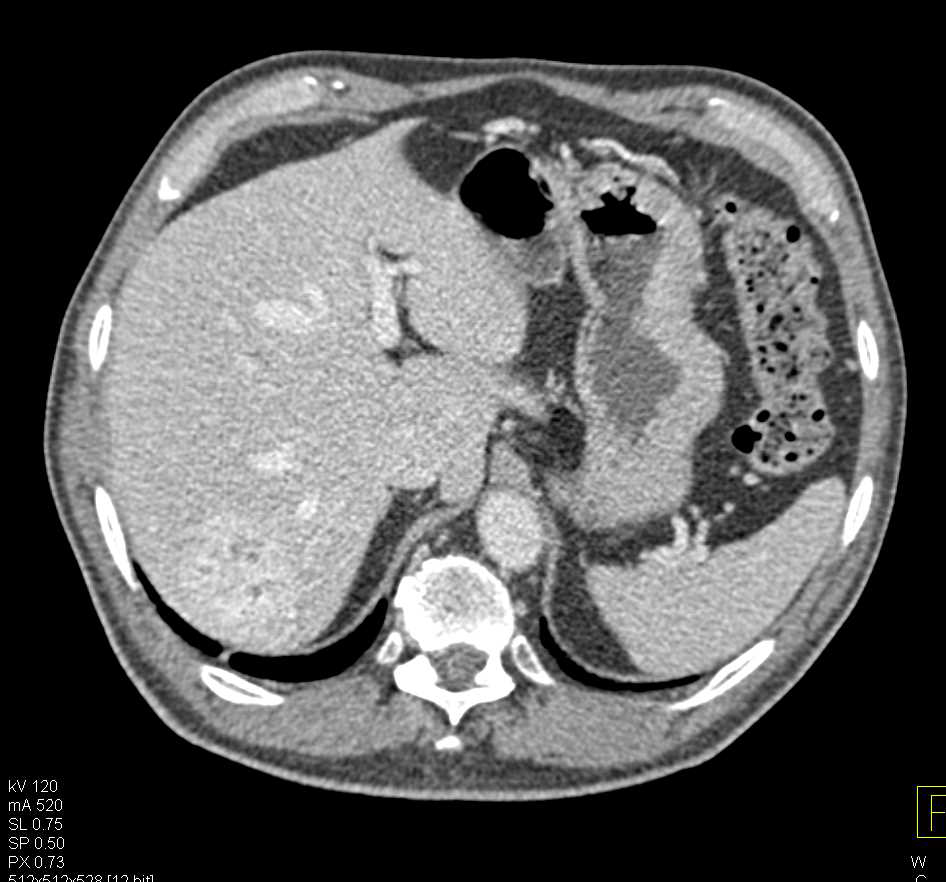 Hepatic Hemangioma - Liver Case Studies - CTisus CT Scanning