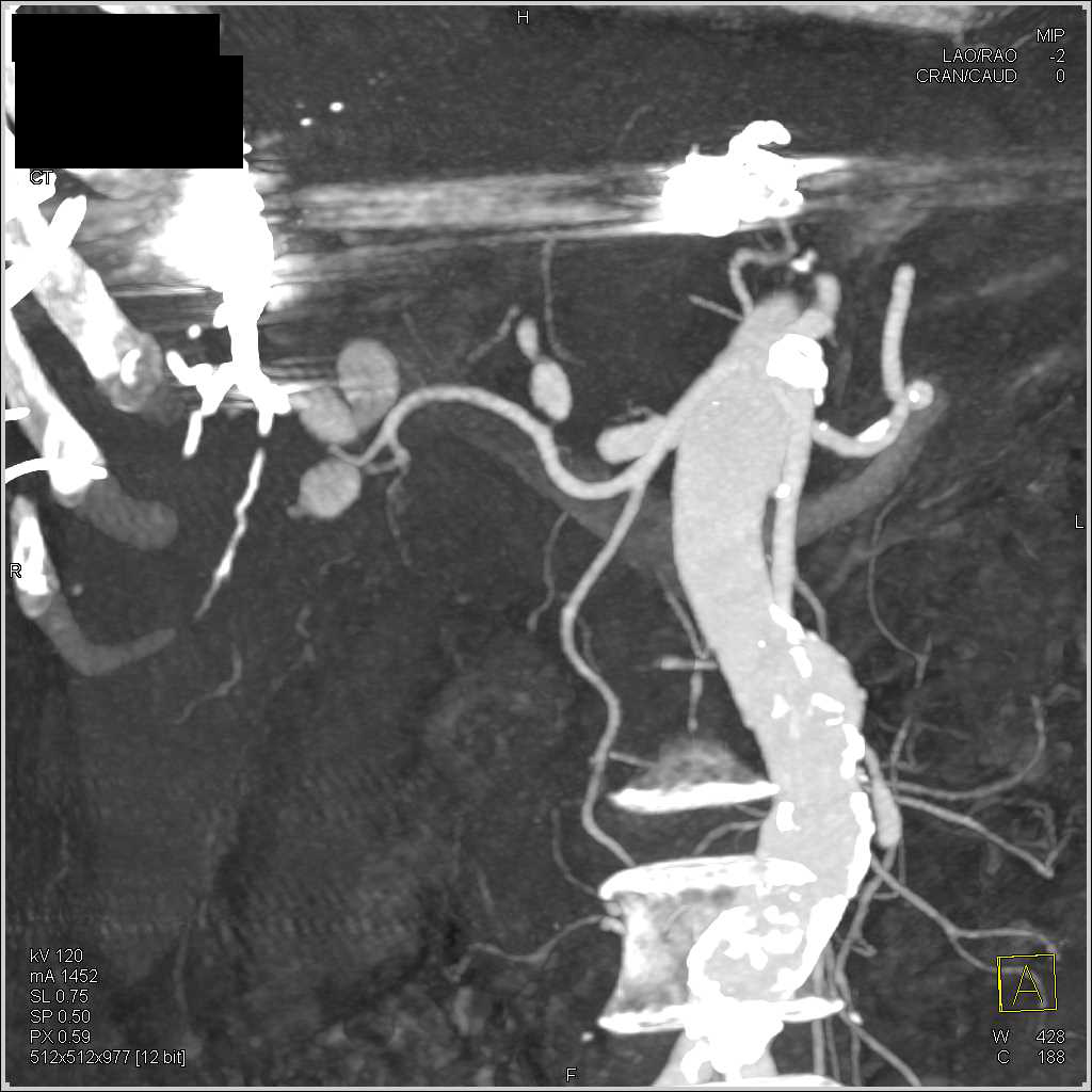 Embolization of an Arteriovenous (AV) Fistulae in the Liver - CTisus CT Scan