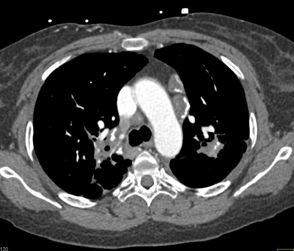 Lung Cancer with Liver Metastases Liver Case Studies