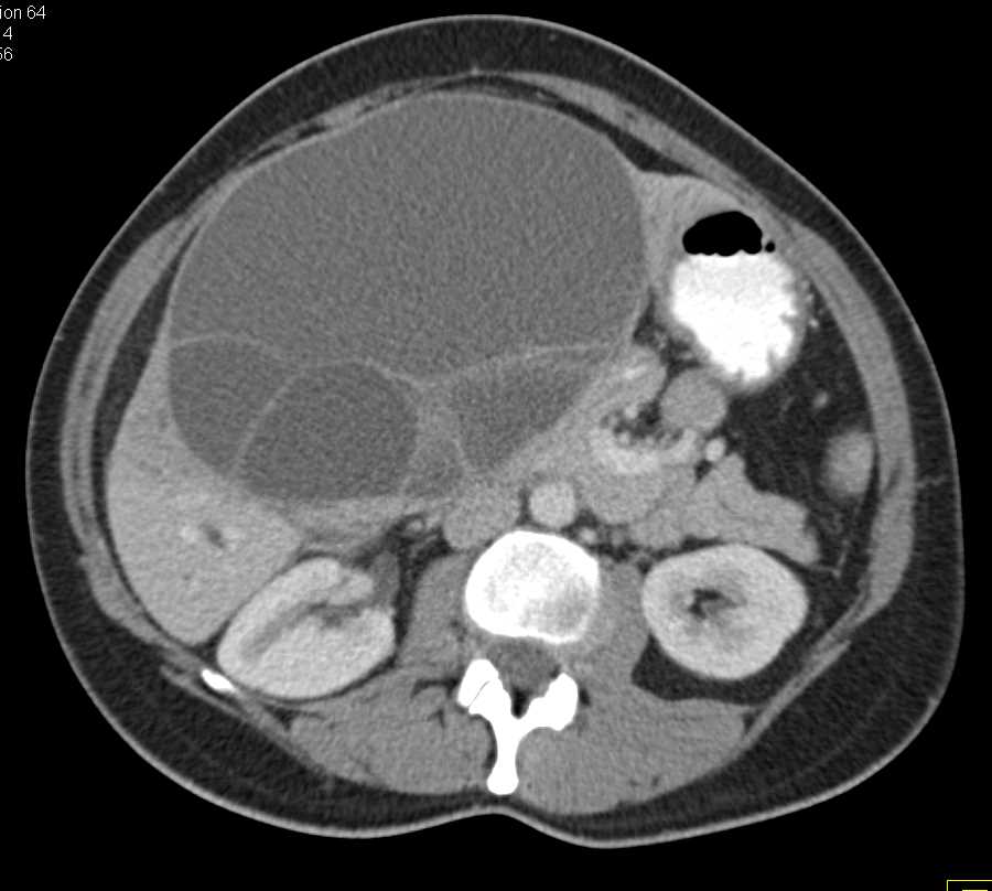 Biliary Cystadenoma - Liver Case Studies - CTisus CT Scanning