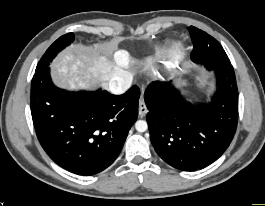 Metastatic Neuroendocrine Tumor to the Liver Best Seen on Arterial