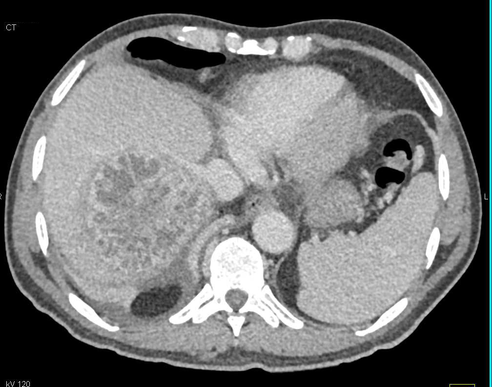Liver Abscess - Liver Case Studies - CTisus CT Scanning