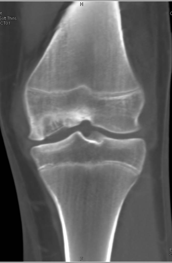 Avascular Necrosis of Medial Femoral Condyle - Musculoskeletal Case
