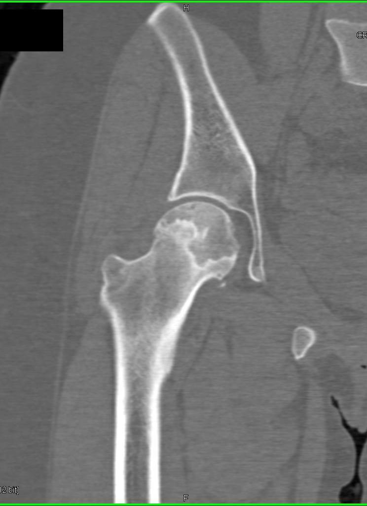 Avascular Necrosis with CT Crescent Sign for AVN - Musculoskeletal Case