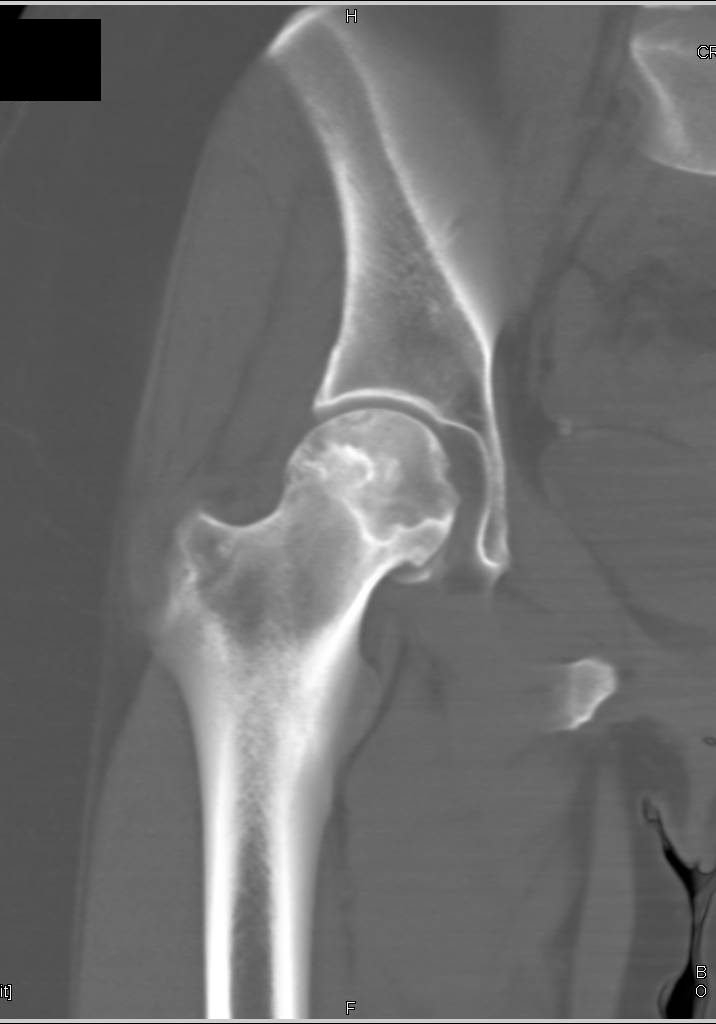 Avascular Necrosis with CT Crescent Sign for AVN - Musculoskeletal Case