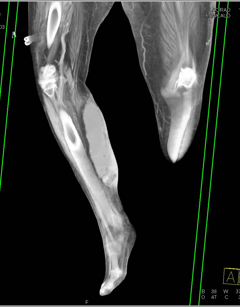 Hematoma in the Calf - Musculoskeletal Case Studies - CTisus CT Scanning