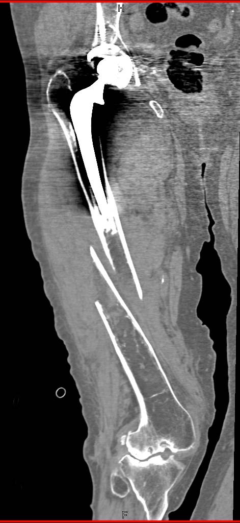 what-is-the-treatment-for-a-spiral-fracture-of-the-femur