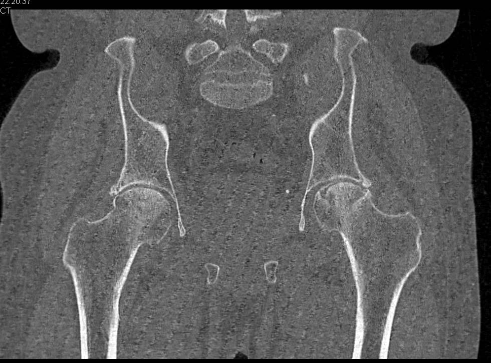 Avascular Necrosis both Femoral Heads but Worse on the Left Side