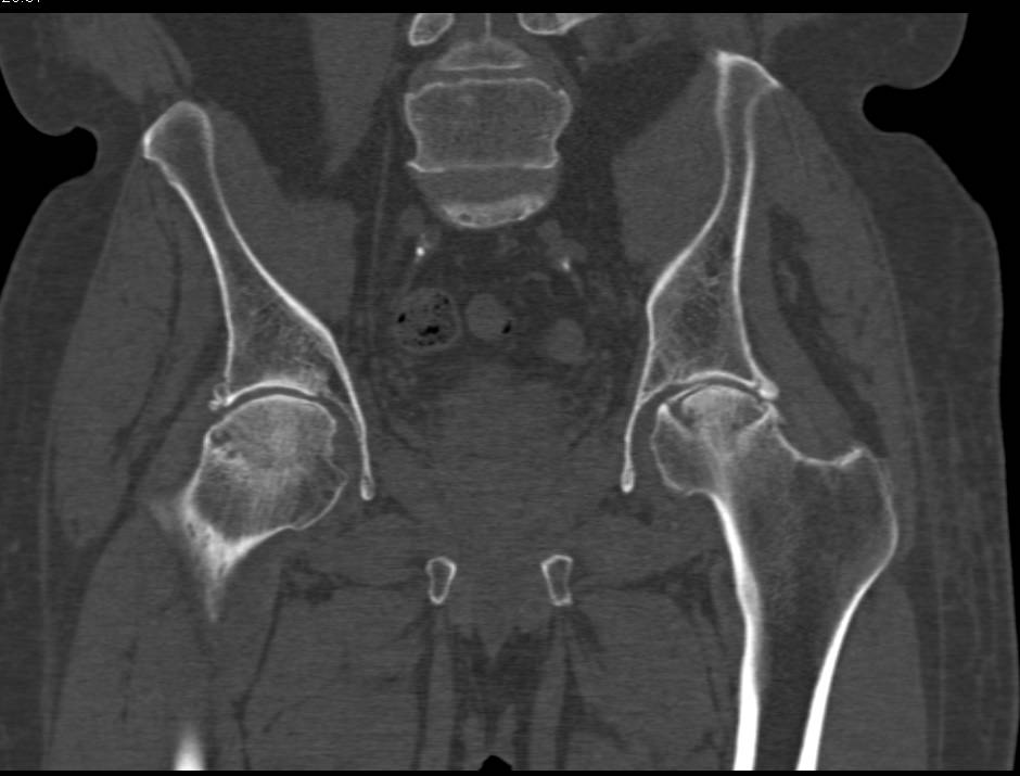 Avascular Necrosis both Femoral Heads but Worse on the Left Side
