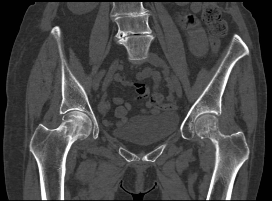 Bilateral Avascular Necrosis of the Femoral Heads - Musculoskeletal