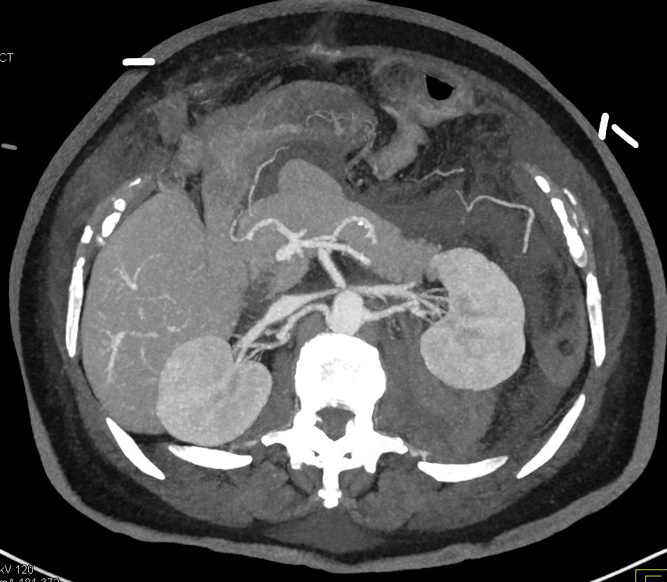 Muscle Spasm Upper Left Quadrant 79