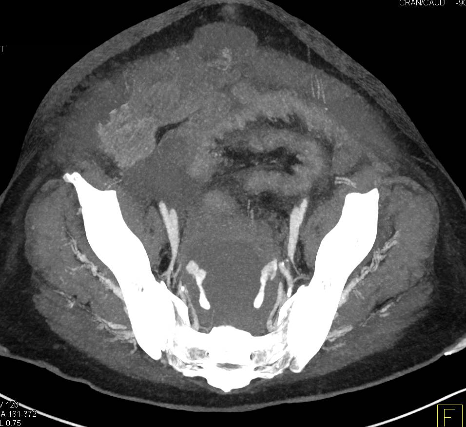 Muscle Spasm Upper Left Quadrant 102