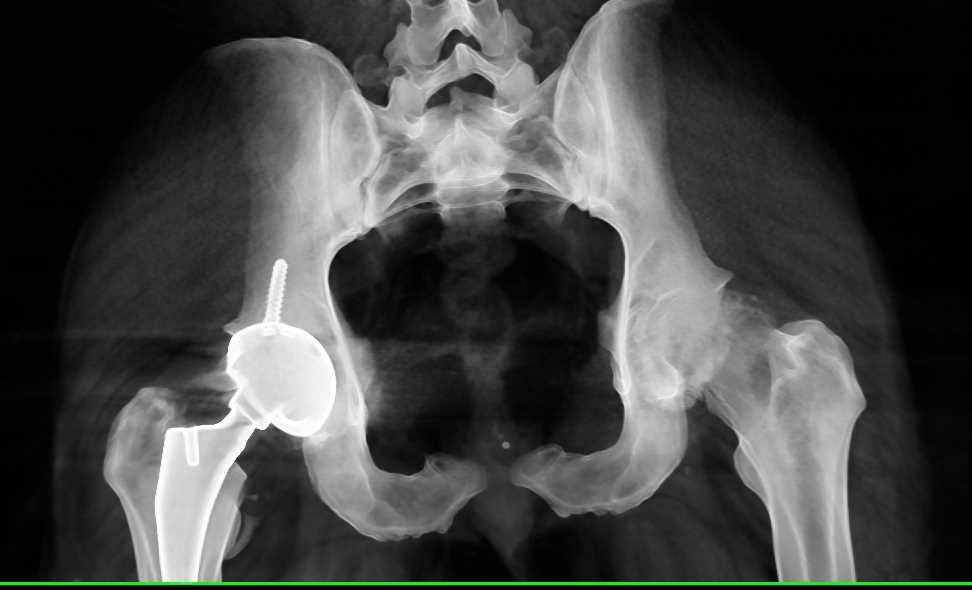3D of a Right Total Hip Replacement - Musculoskeletal Case Studies