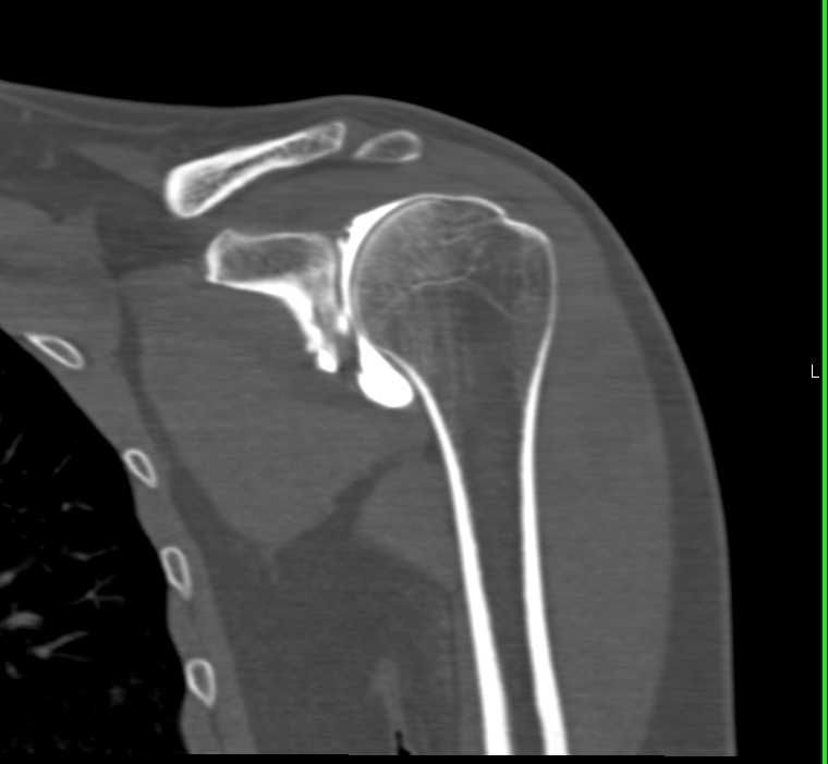 CT Shoulder Arthrogram in 3D - Musculoskeletal Case Studies - CTisus CT