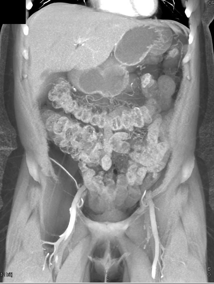 Lipoma Extends into Right Inguinal Ring - Musculoskeletal Case Studies - CTisus CT Scanning