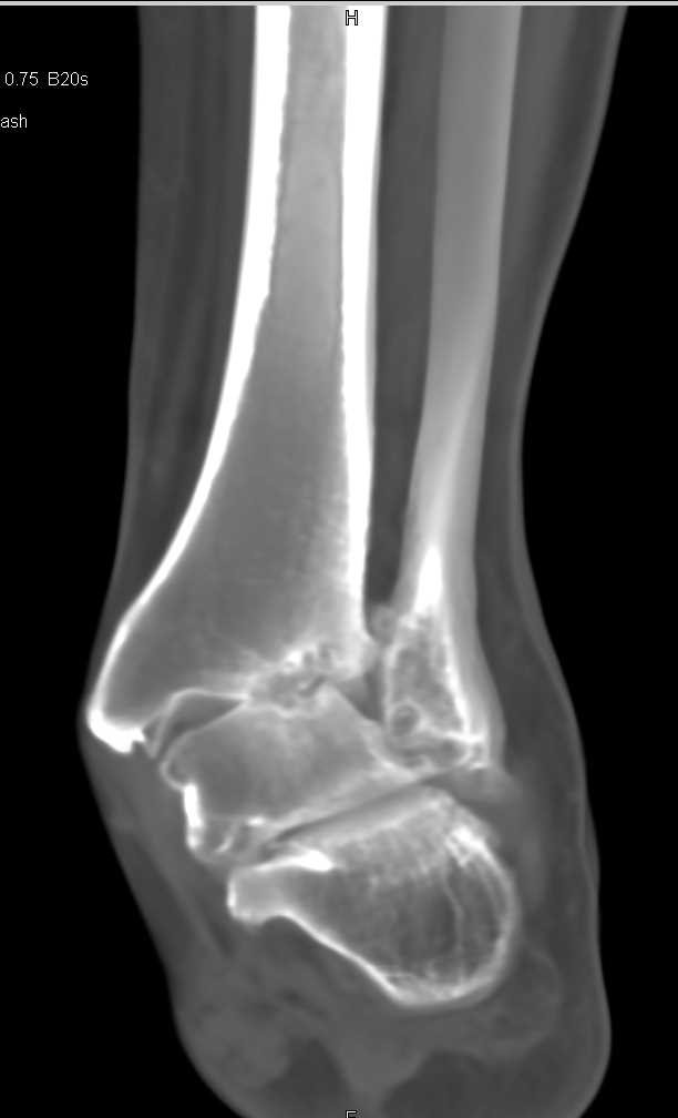 Degenerative Change in the Ankle Joint - Musculoskeletal Case Studies