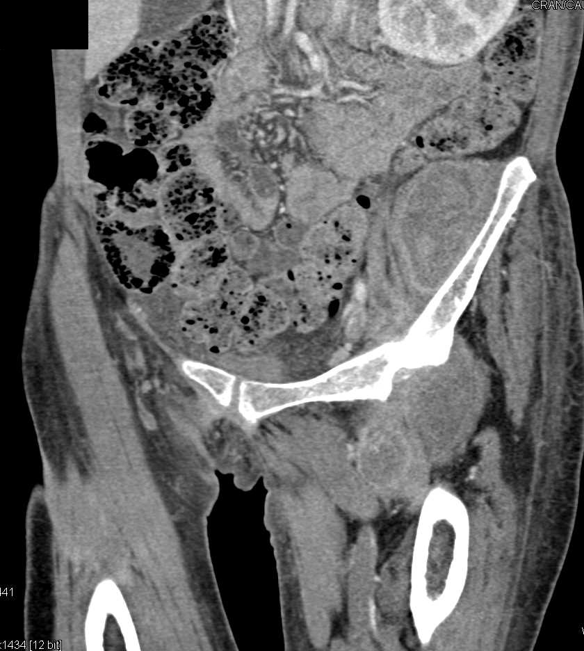 Left Iliopsoas Abscess With Extension To Left Hip Joint