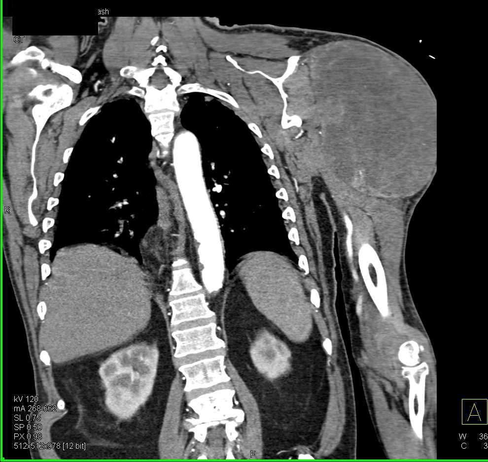 Sarcoma Left Shoulder with Cardiac Metastases - CTisus CT Scan