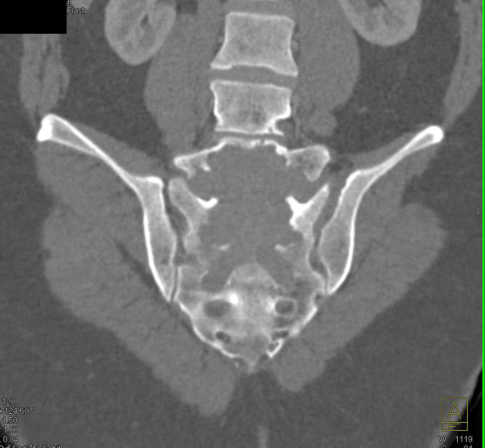 Sacral Chordoma - Musculoskeletal Case Studies - CTisus CT Scanning