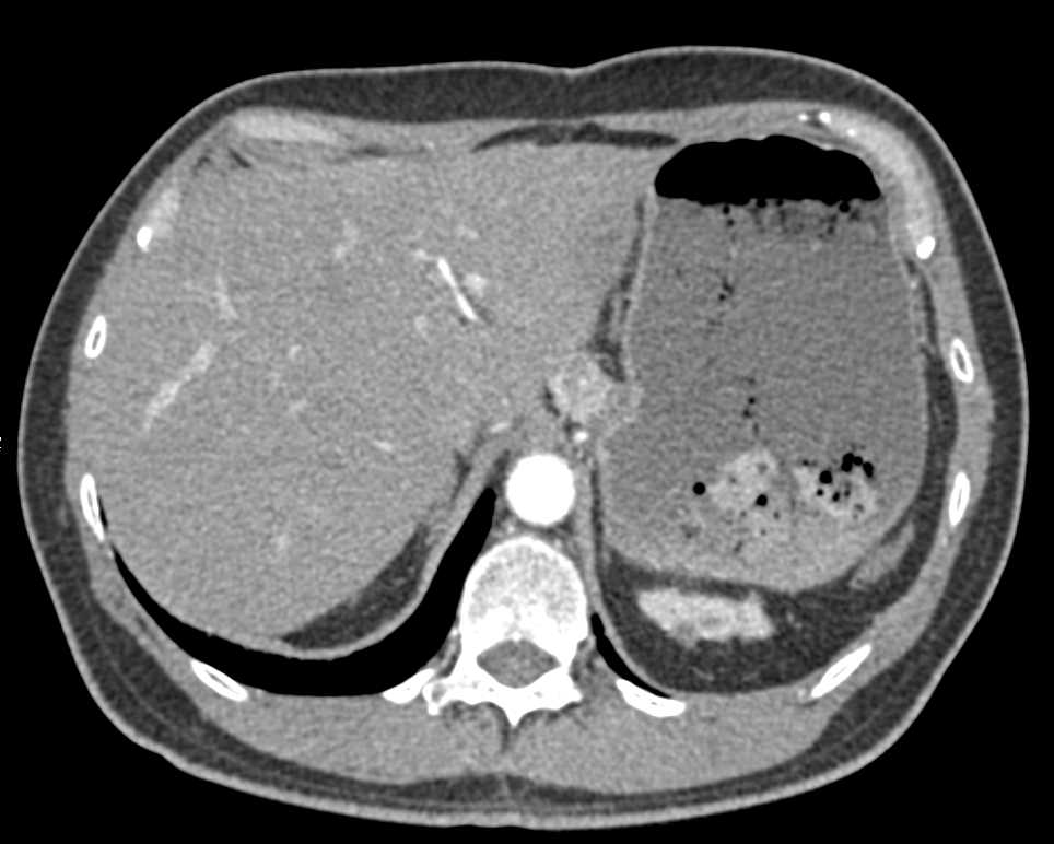 Incidental Vascular Liver Metastases in a Patient with a Pathologic Femur Fracture - CTisus CT Scan