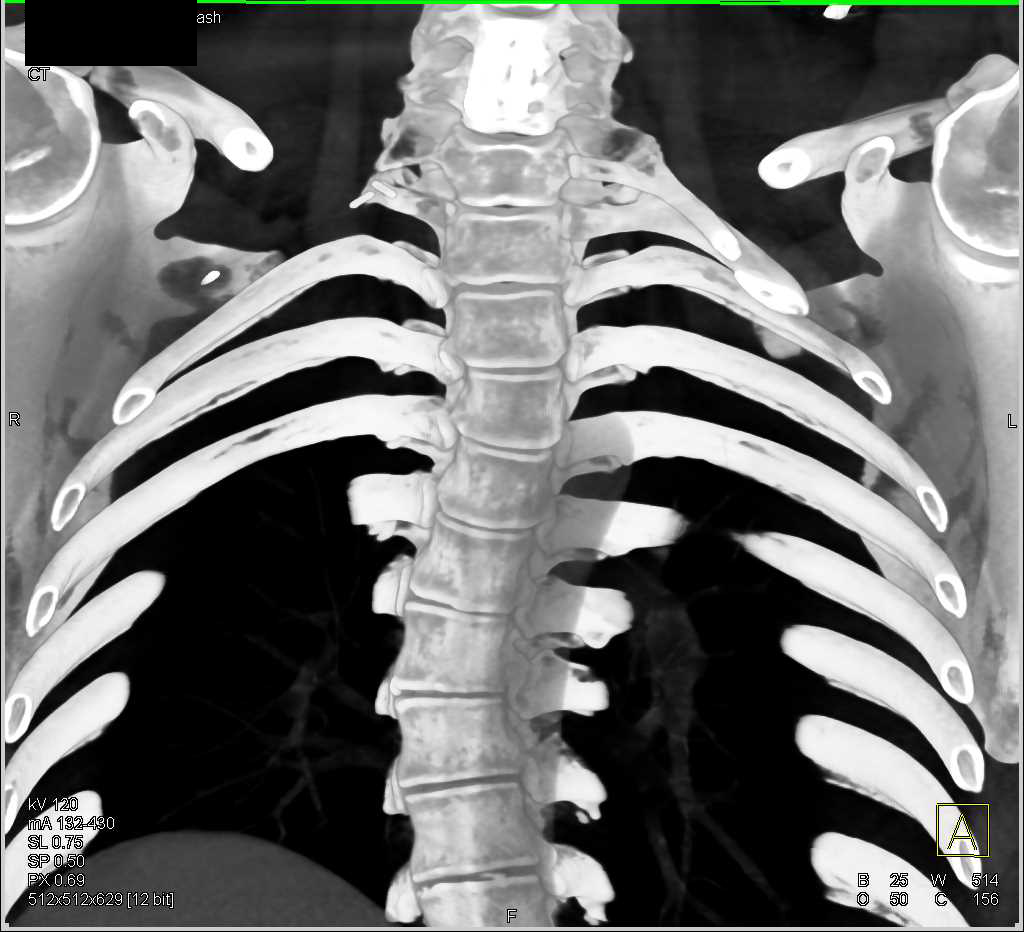Cervical Ribs With Prior Resection On The Right Side Musculoskeletal