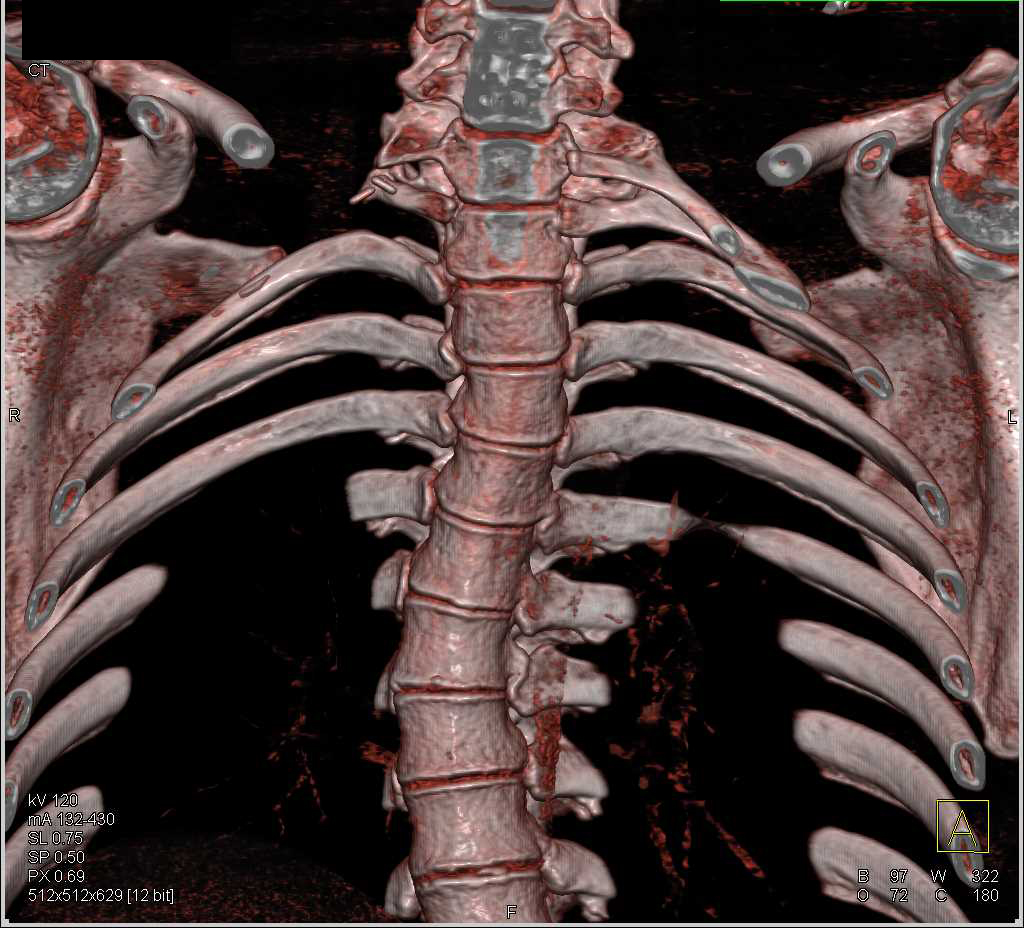 Cervical Ribs With Prior Resection on the Right Side - Musculoskeletal