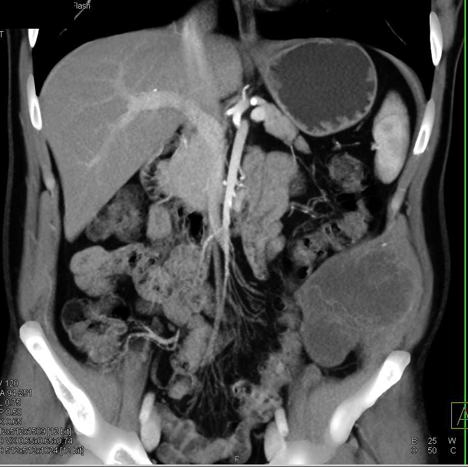 Sarcoma Abdominal Petrus Maximinus