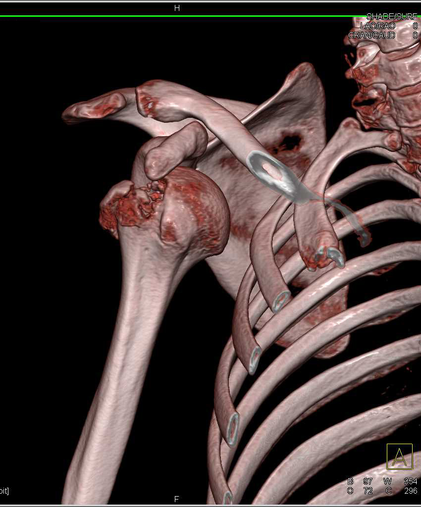 Fracture Dislocation Right Shoulder Musculoskeletal Case Studies