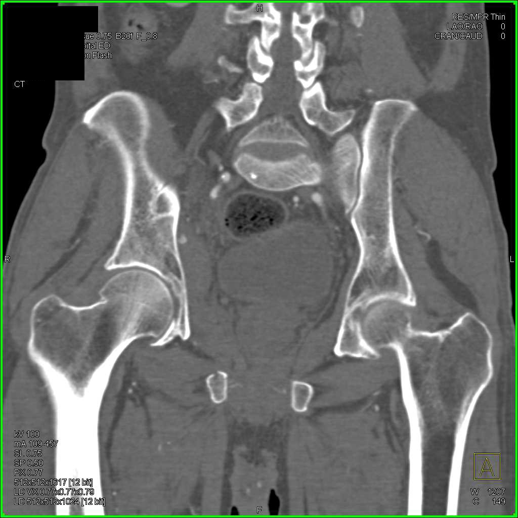 Right Hip Joint Effusion and Normal CTA - Musculoskeletal Case Studies
