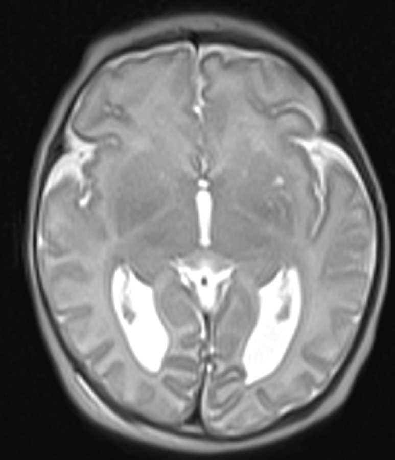 Corpus Callosum Agenesis - Neuro MR Case Studies - CTisus CT Scanning