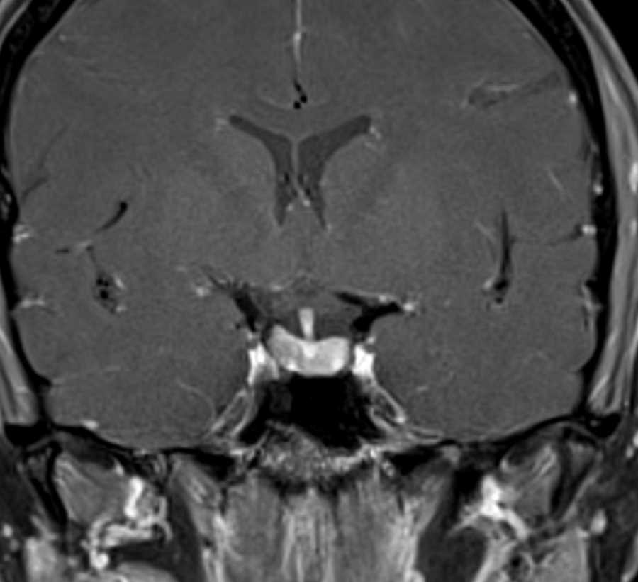 Pituitary Microadenoma - CTisus CT Scan