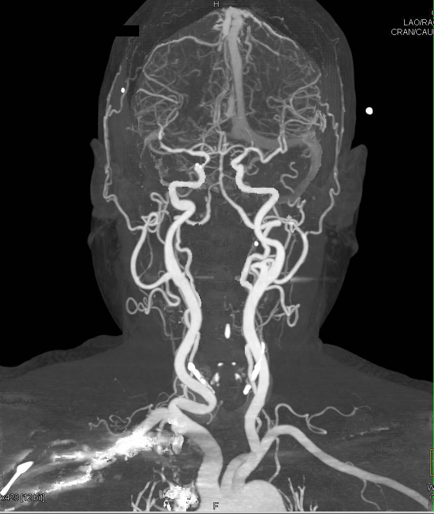 CT Angiography of the Carotid and Cerebral Circulation With Single