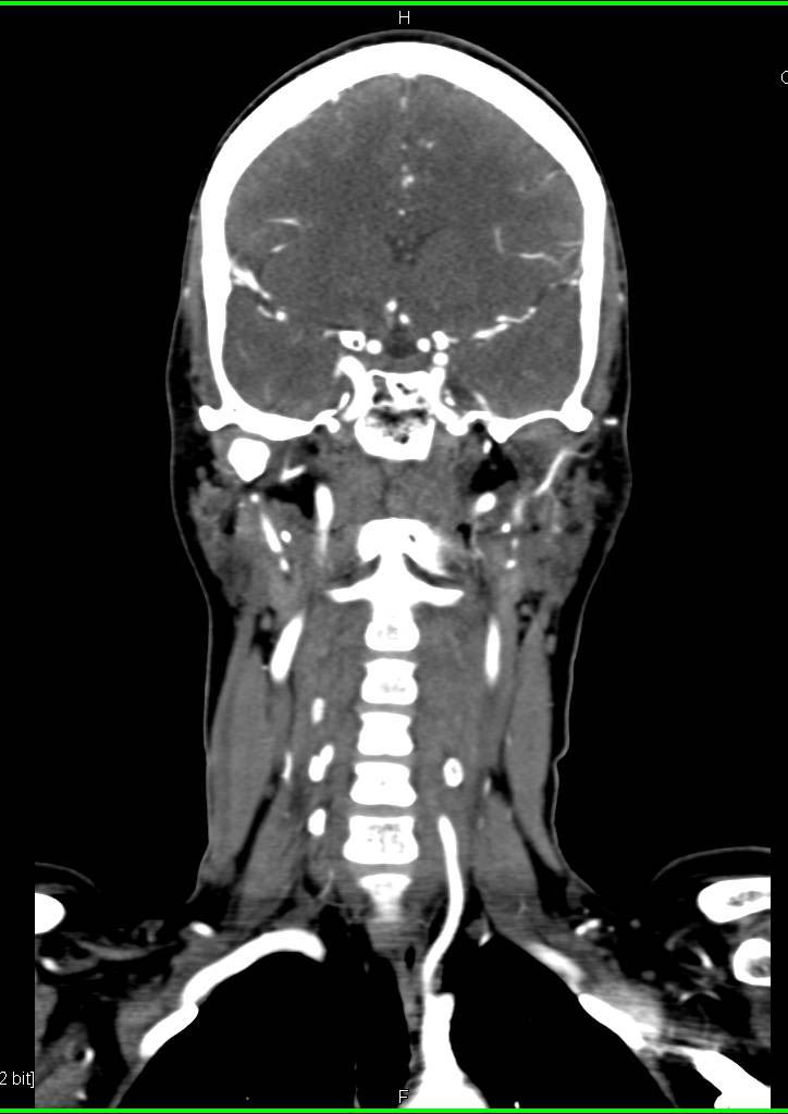 Normal CTA of the Head and Neck - Neuro Case Studies - CTisus CT Scanning