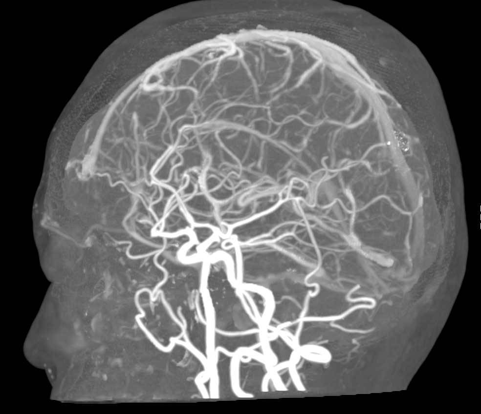 CTA of Circle of Willis - Neuro Case Studies - CTisus CT Scanning