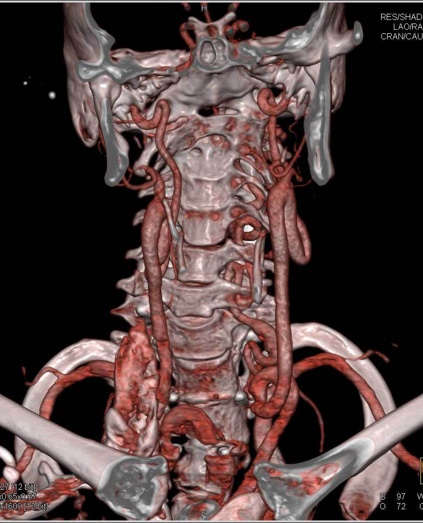 tortuous-carotid-and-vertebral-arteries-in-a-loeys-dietz-patient