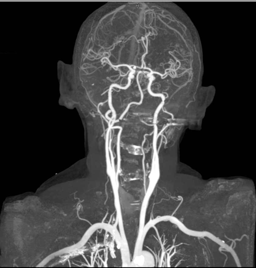 Cta Of The Carotid Arteries With Dual Energy Neuro Case Studies