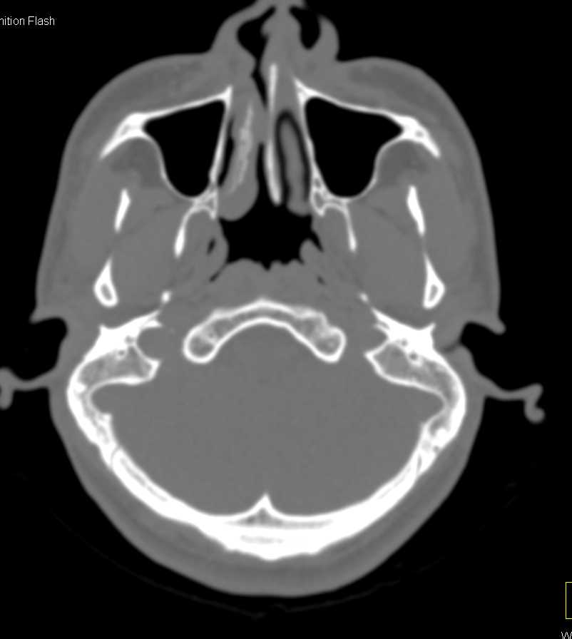 Thickening Nasal Mucosa - CTisus CT Scan