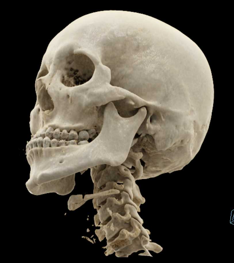 Normal Temporomandibular Joints (TMJ) - CTisus CT Scan